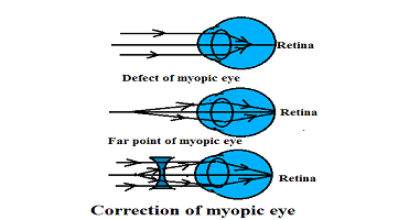 Mi a szemész hyperopia és a myopia?