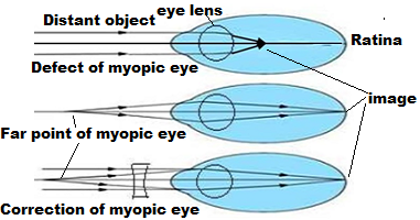 correction of myopic eye