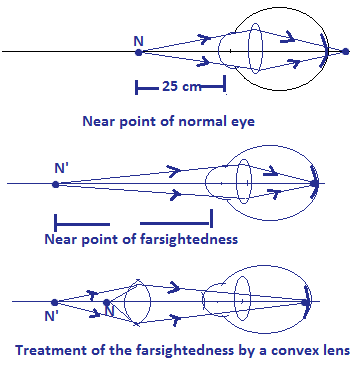 Treatment of farsightedness by a convexlens