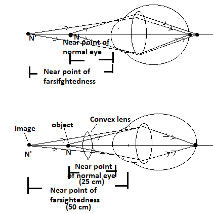 The treatment of hypermetropia using a convex lens